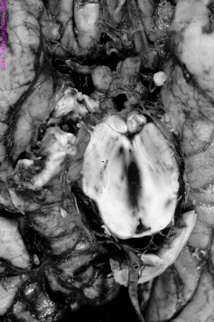 Transtentorial herniation with secondary midbrain hemorrhage